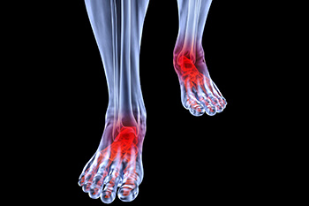 Arthritic foot and ankle care treatment in the Midtown Manhattan, New York, NY 10036 area