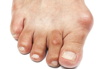 Bunions treatment in the Midtown Manhattan, New York, NY 10036
