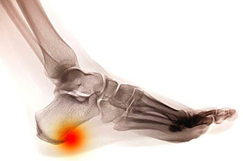 Heel spurs treatment in the Midtown Manhattan, New York, NY 10036 area