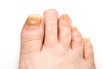 Fungal toenails treatment in the Midtown Manhattan, New York, NY 10036 area