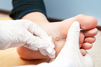 Plantar warts treatment in the Midtown Manhattan, New York, NY 10036